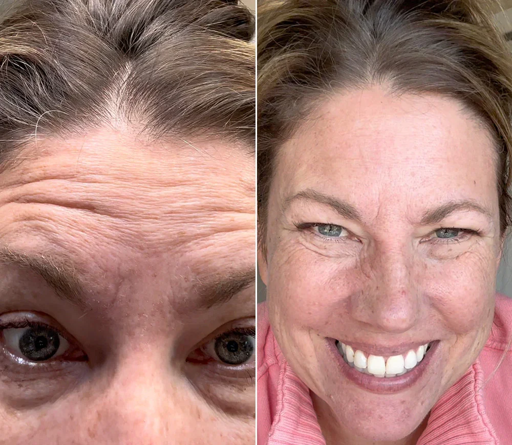 Antes y después del uso de la mascarilla de colágeno